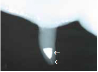 Figure 6. Radiograph of a teat
infused with teat seal, illustrating
the teat seal material in the distal
teat cistern and in the teat canal
(arrows).